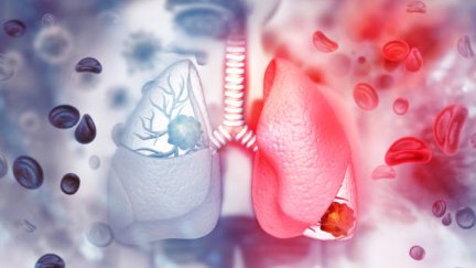 En España mueren al año 23.000 personas por cáncer de pulmón. / Pixabay.