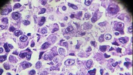 Biopsia de un osteosarcoma vista a la luz del microscopio. / Canva