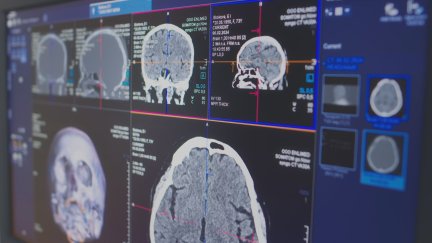Radiografías de paciente con epilepsia./ Aragón TV
