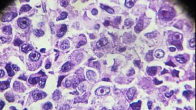 Biopsia de un osteosarcoma vista a la luz del microscopio. / Canva