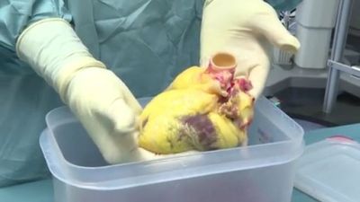 Un corazón a la espera de ser trasplantado. / Aragón Tv