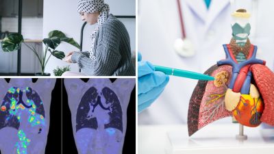 Colorrectal, mama y pulmón son los cánceres más frecuentes. / Canva